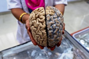 a formalin fixed human brain